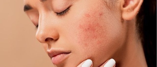 salicylic acid spot treatment